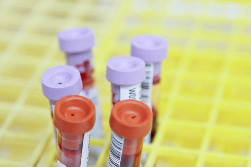 Blood sample tubes with purple and orange caps in a laboratory rack.